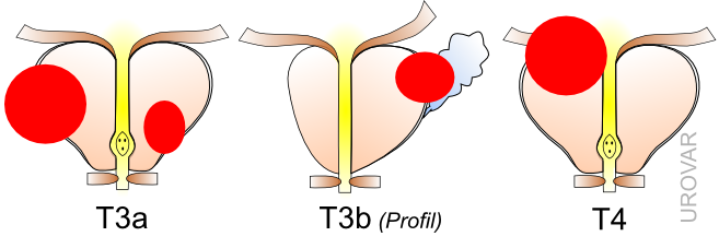 Classification TNM / Gleason / ISUP Du Cancer De Prostate - Centre D ...